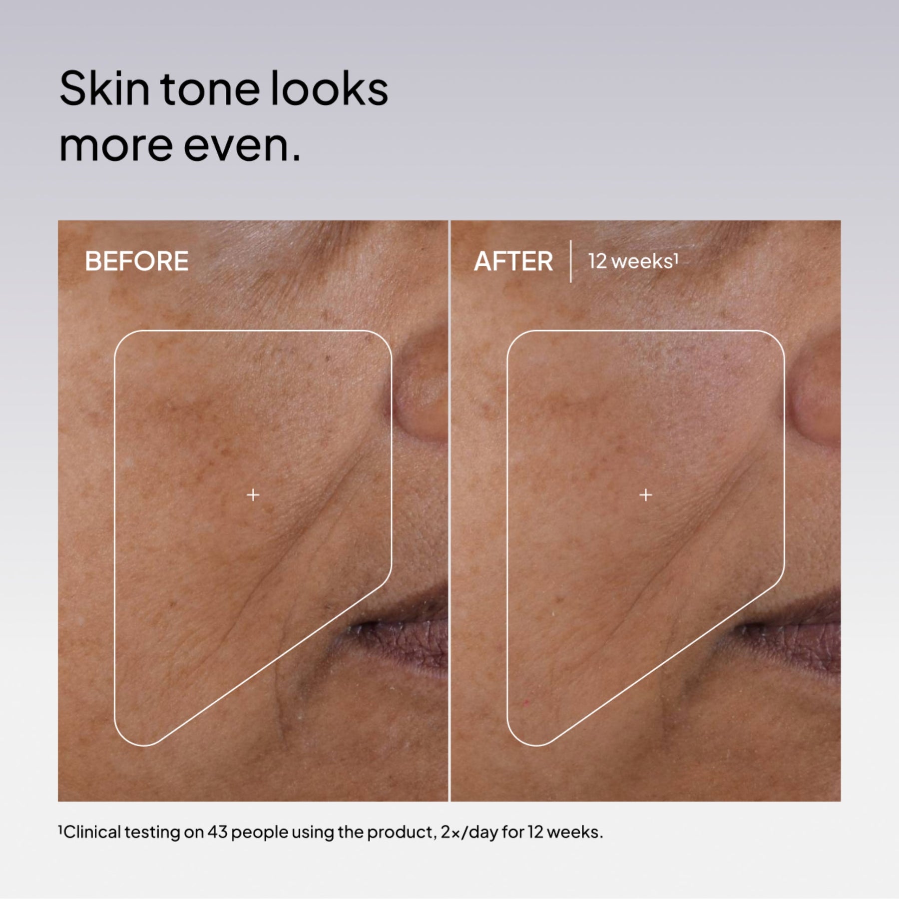 NIOD Multi Molecular Hyaluronic Complex MMHC2 - before and after