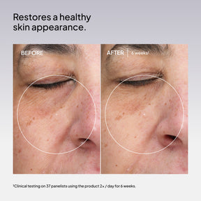 Niod Superoxide Dismutase 3 Enzyme Mist (SDEM3) before and after